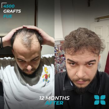 Before After