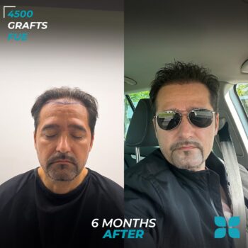 Before After