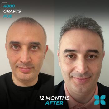 Before After