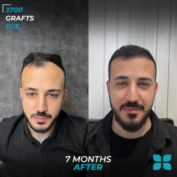 Before After