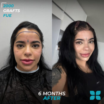 Before After
